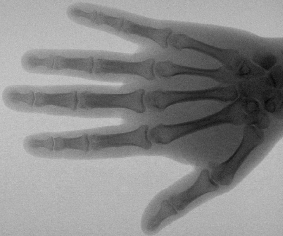 Физик Вильгельм Рентген открыл «рентгеновские лучи»